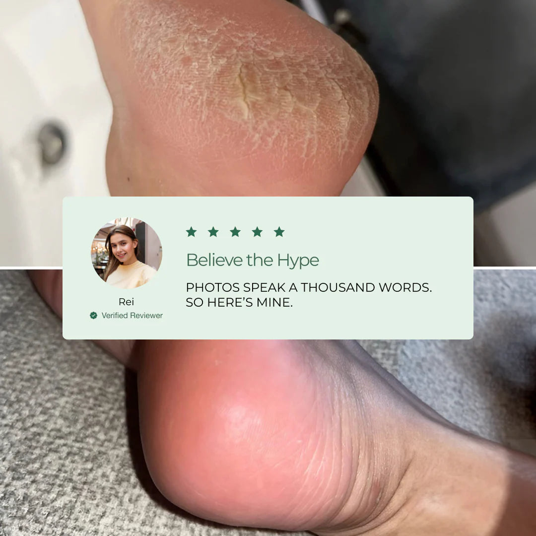 Peelology™ – The #1 Dermatologist-Tested Mask for Cracked Heels & Callus Removal