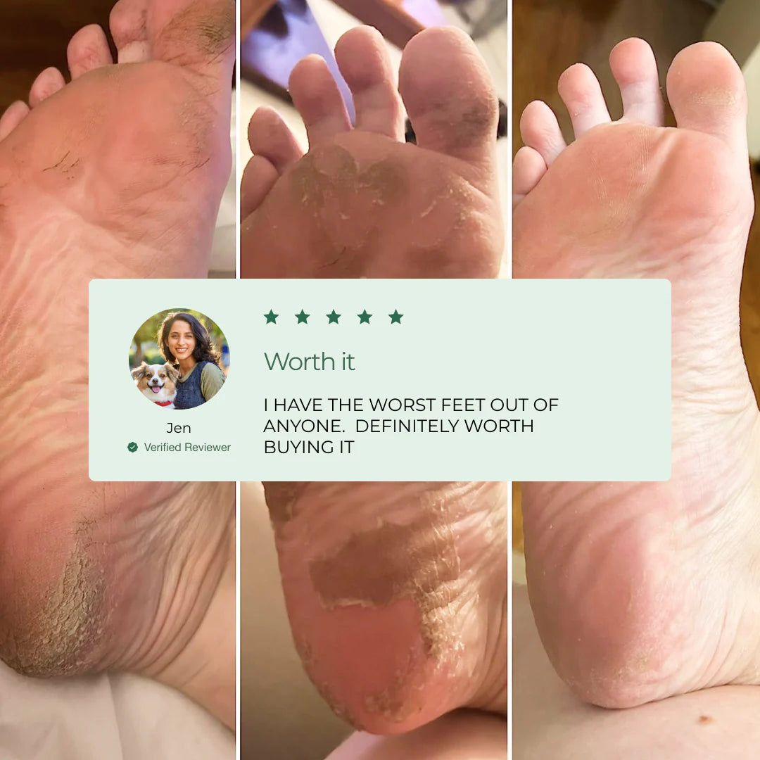 Peelology™ – The #1 Dermatologist-Tested Mask for Cracked Heels & Callus Removal